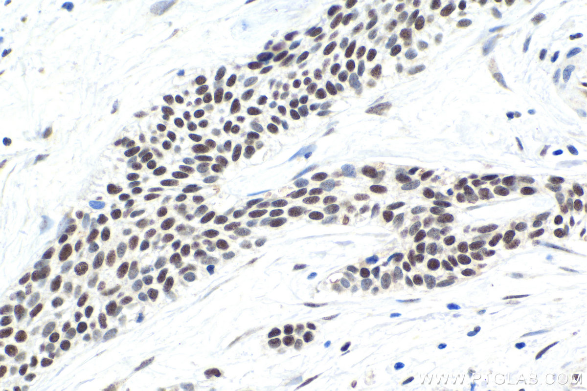 Immunohistochemistry (IHC) staining of human urothelial carcinoma tissue using SFRS9 Polyclonal antibody (17926-1-AP)