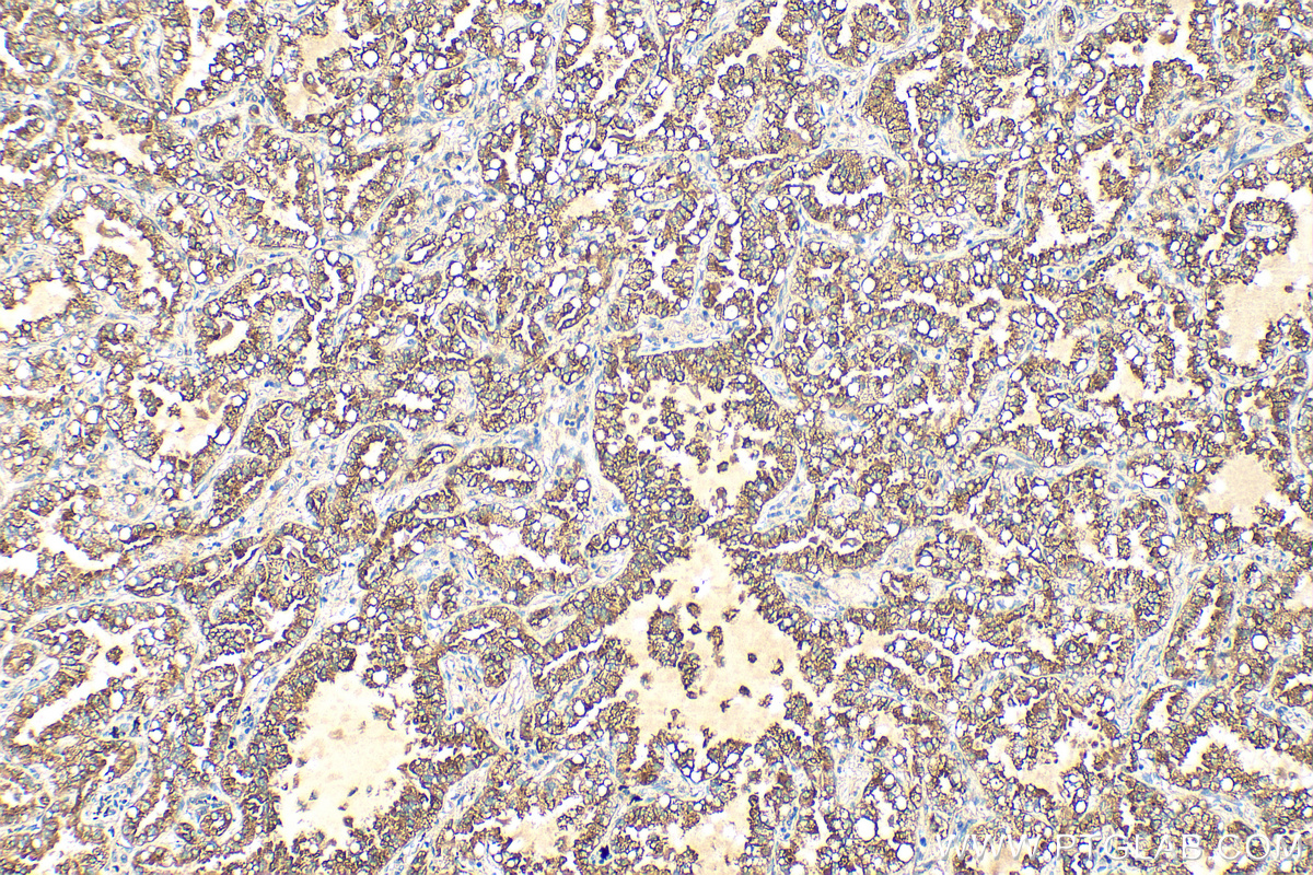 Immunohistochemistry (IHC) staining of human lung cancer tissue using SFTPB Polyclonal antibody (13664-1-AP)