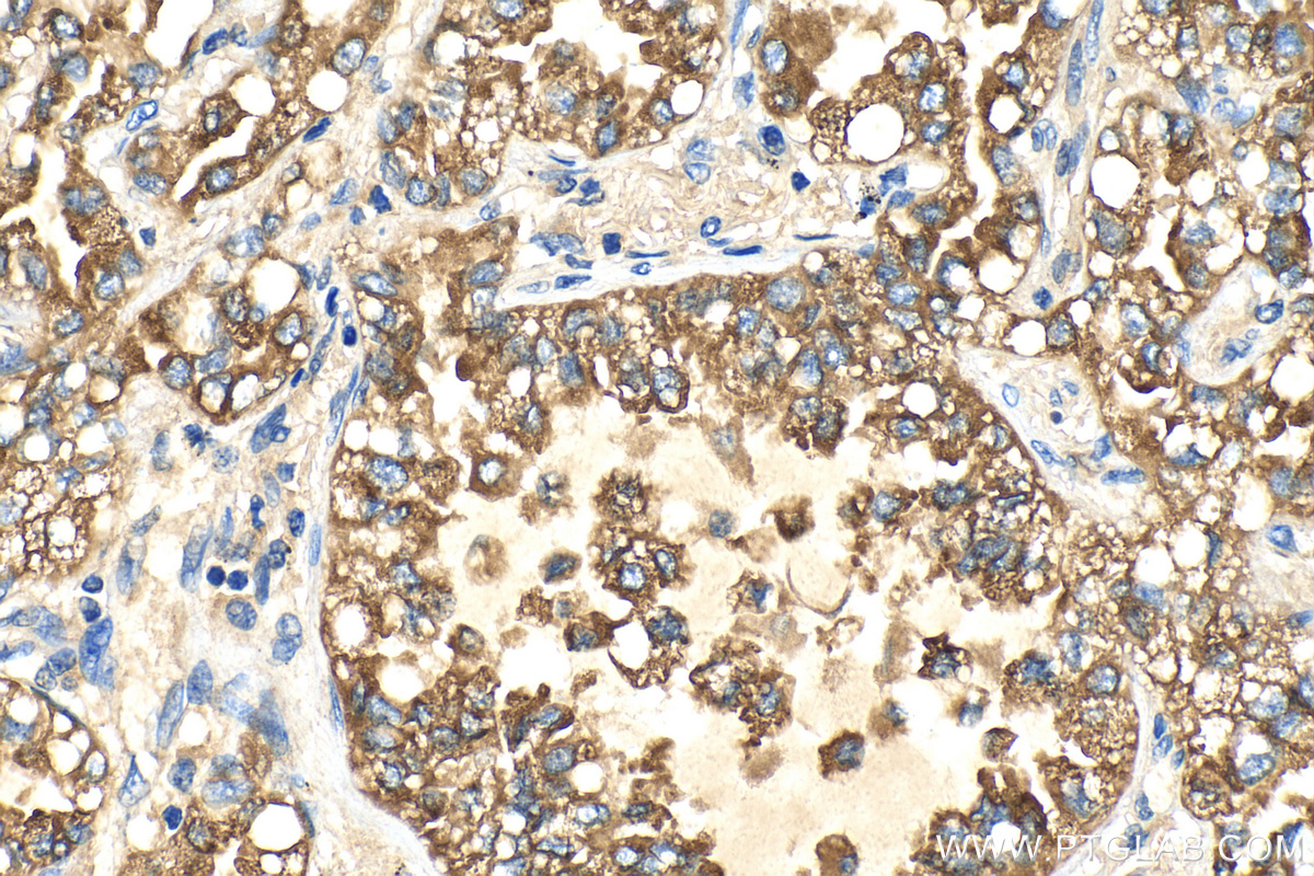 Immunohistochemistry (IHC) staining of human lung cancer tissue using SFTPB Polyclonal antibody (13664-1-AP)