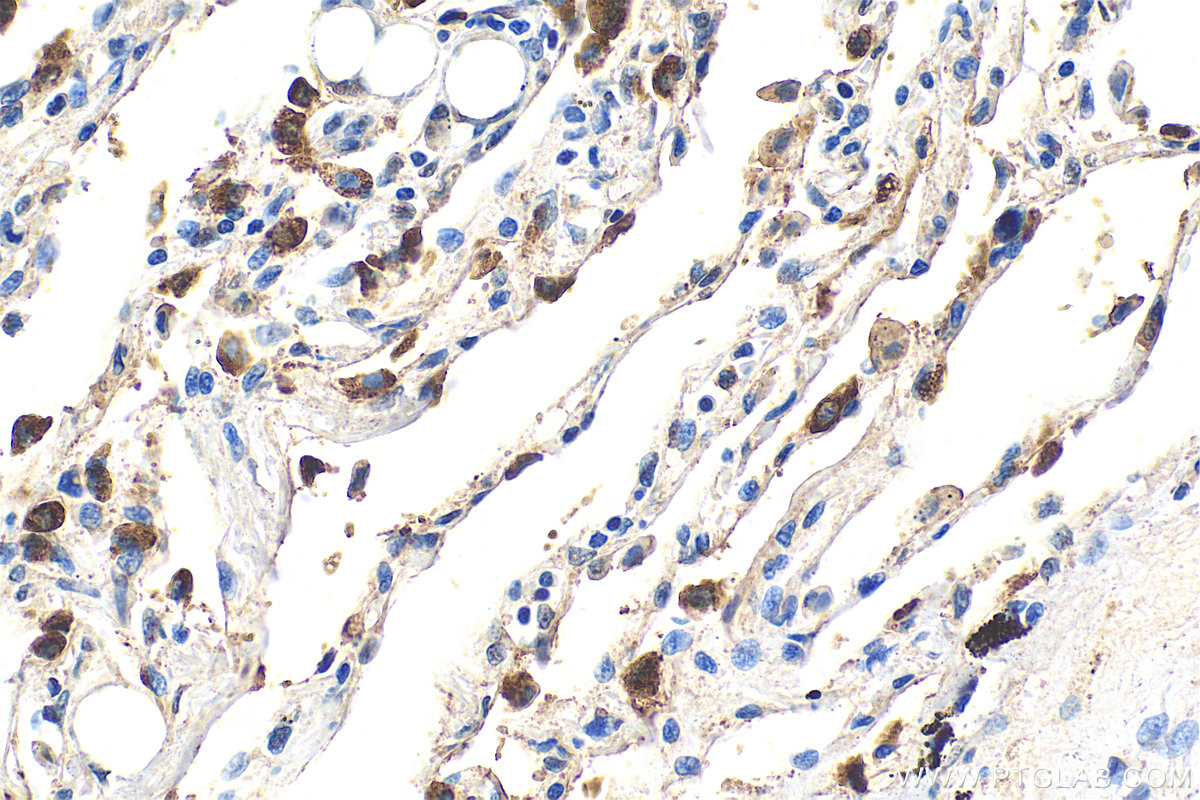 Immunohistochemistry (IHC) staining of human lung tissue using SFTPC Polyclonal antibody (10774-1-AP)