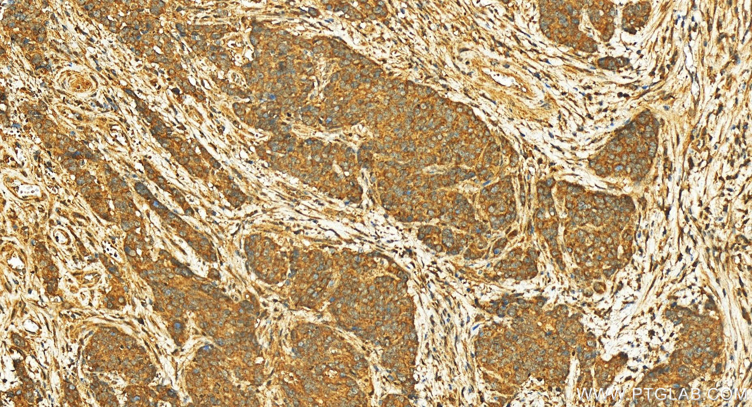 Immunohistochemistry (IHC) staining of human stomach cancer tissue using SGCE Polyclonal antibody (12407-1-AP)