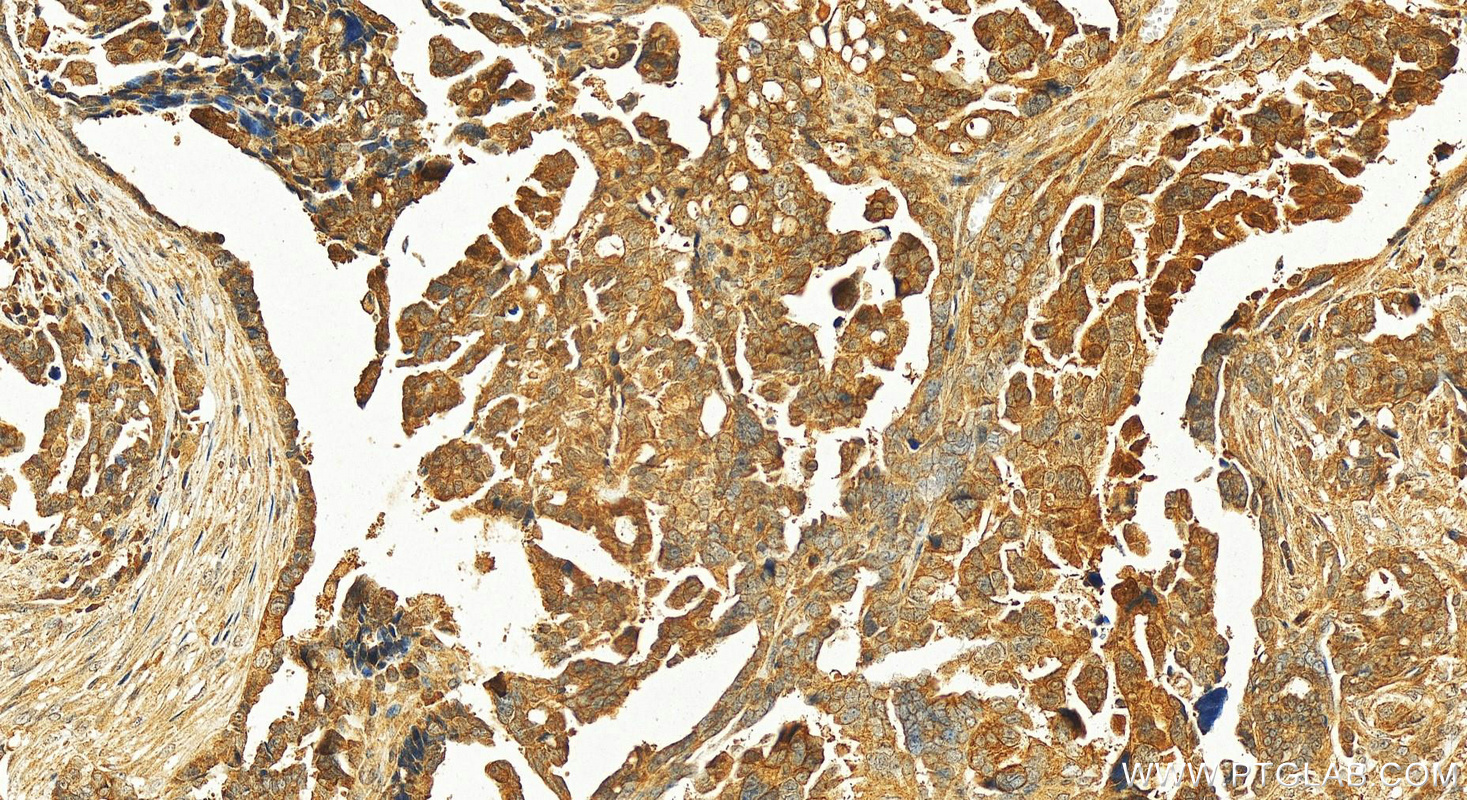 Immunohistochemistry (IHC) staining of human ovary cancer tissue using SH2B1 Polyclonal antibody (12226-1-AP)