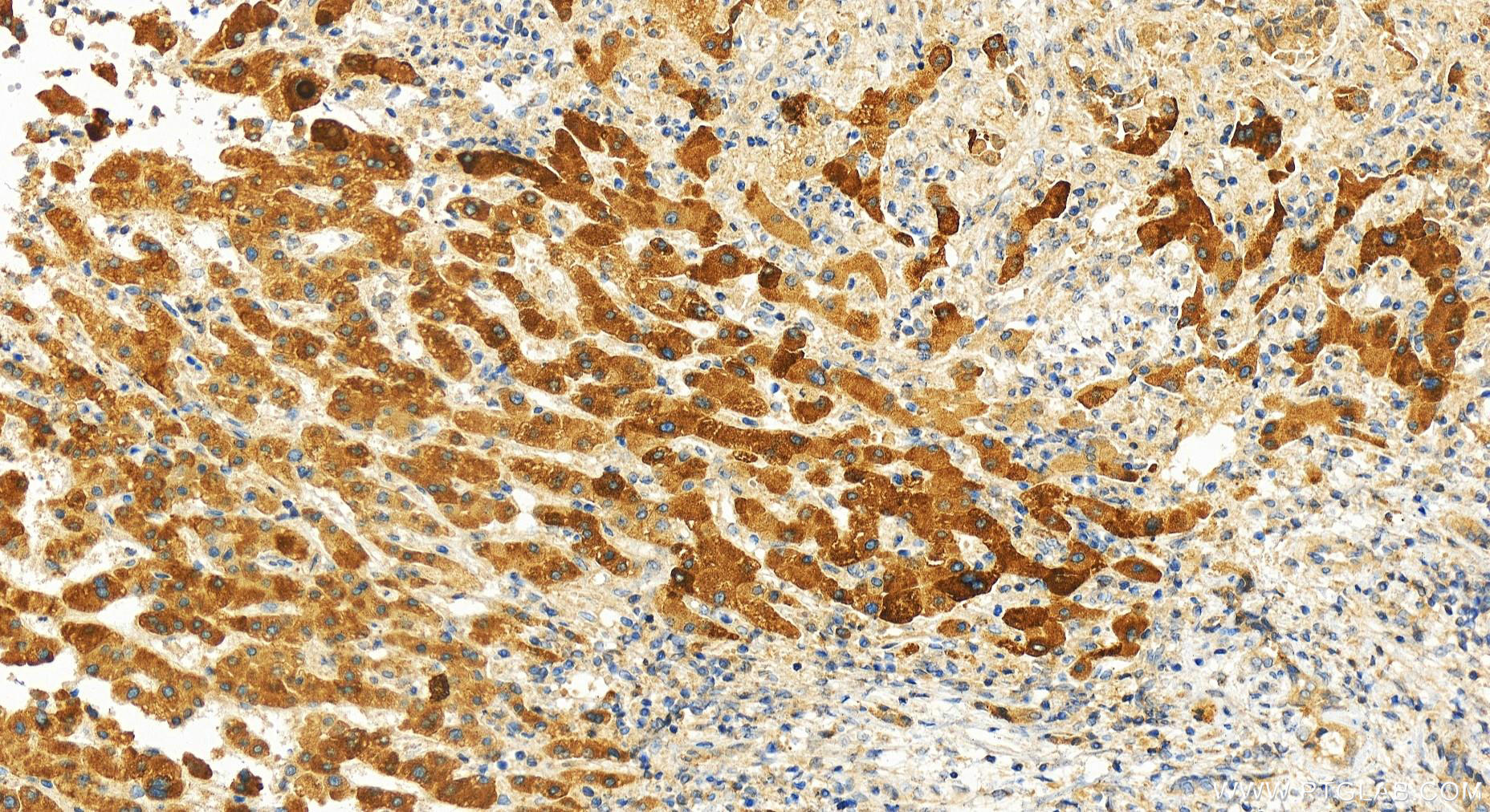 Immunohistochemistry (IHC) staining of human intrahepatic cholangiocarcinoma tissue using SH3BGRL Polyclonal antibody (11253-1-AP)