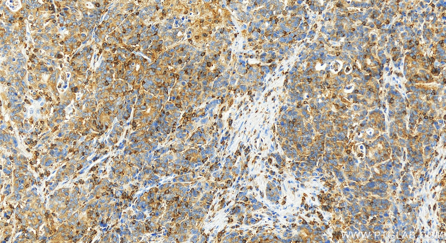 Immunohistochemistry (IHC) staining of human stomach cancer tissue using SH3BP1 Polyclonal antibody (20541-1-AP)