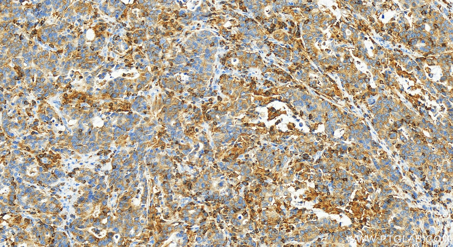 Immunohistochemistry (IHC) staining of human stomach cancer tissue using SH3BP1 Polyclonal antibody (20541-1-AP)