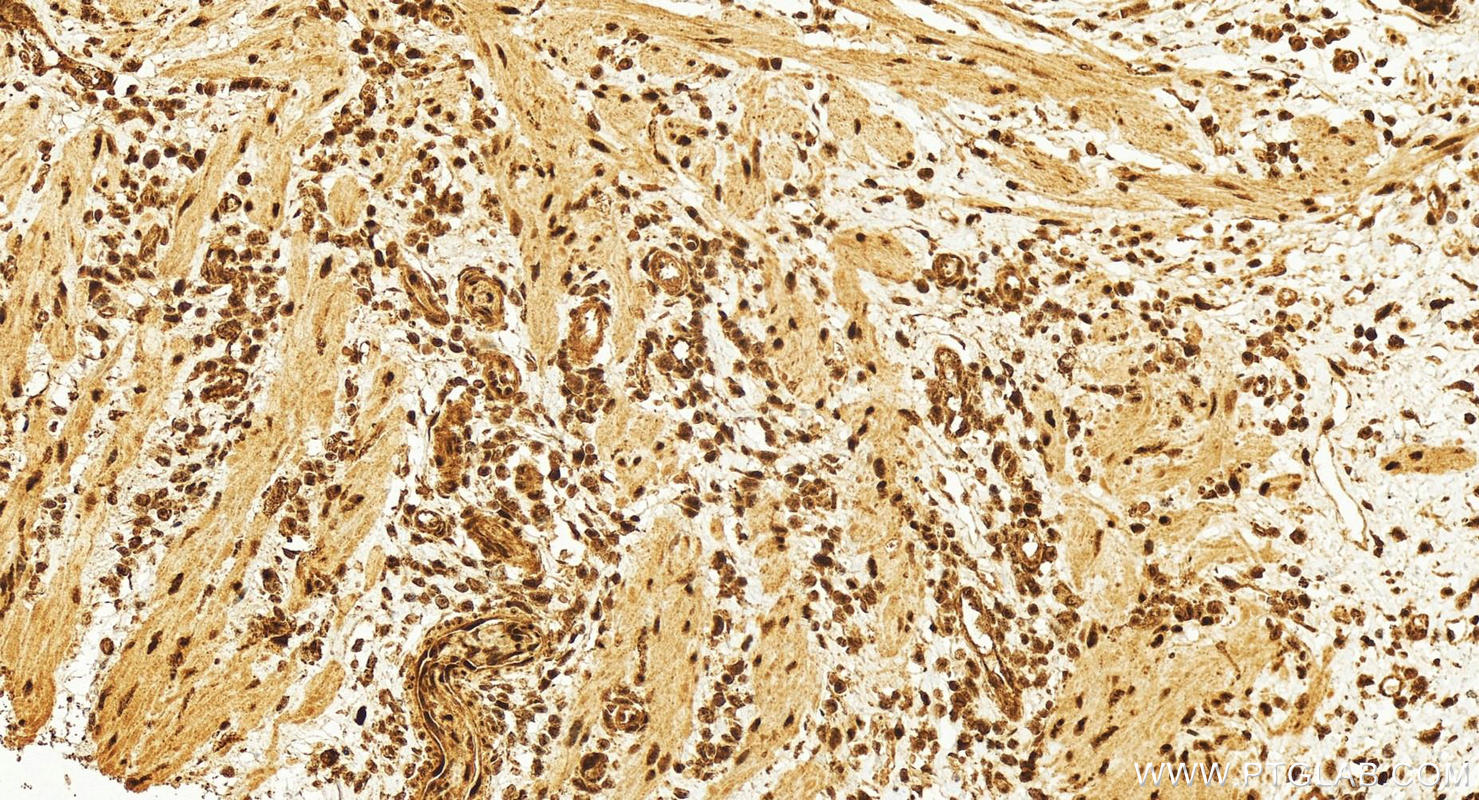 Immunohistochemistry (IHC) staining of human colon cancer tissue using SH3RF2 Polyclonal antibody (13306-1-AP)