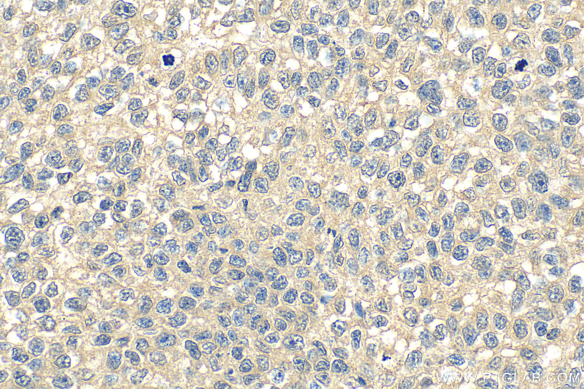 Immunohistochemistry (IHC) staining of human breast cancer tissue using SHCBP1 Monoclonal antibody (68647-1-Ig)
