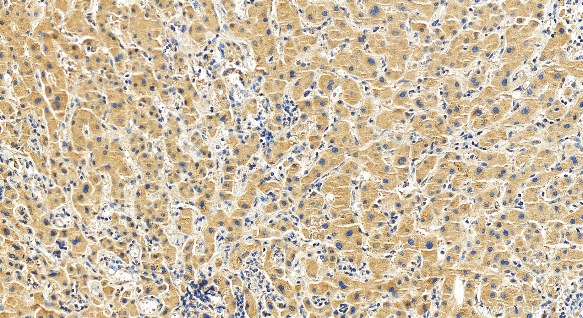 Immunohistochemistry (IHC) staining of human intrahepatic cholangiocarcinoma tissue using SIGIRR Polyclonal antibody (27828-1-AP)