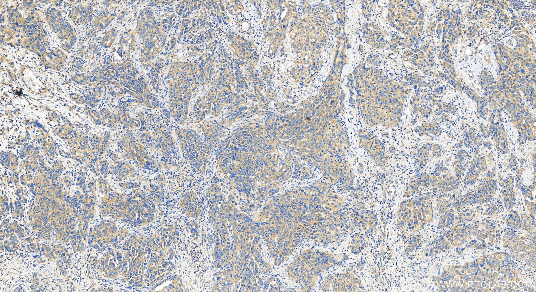 Immunohistochemistry (IHC) staining of human ovary cancer tissue using SIGIRR Polyclonal antibody (27828-1-AP)