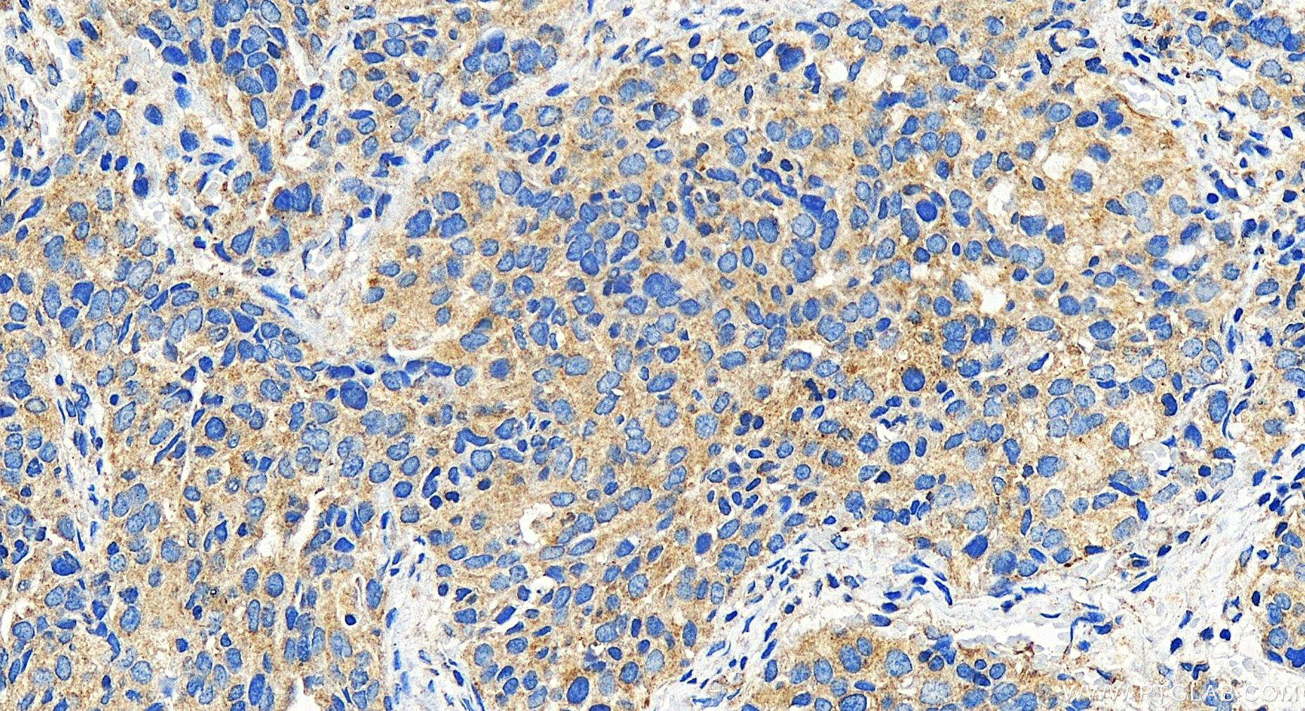 Immunohistochemistry (IHC) staining of human ovary cancer tissue using SIGIRR Polyclonal antibody (27828-1-AP)