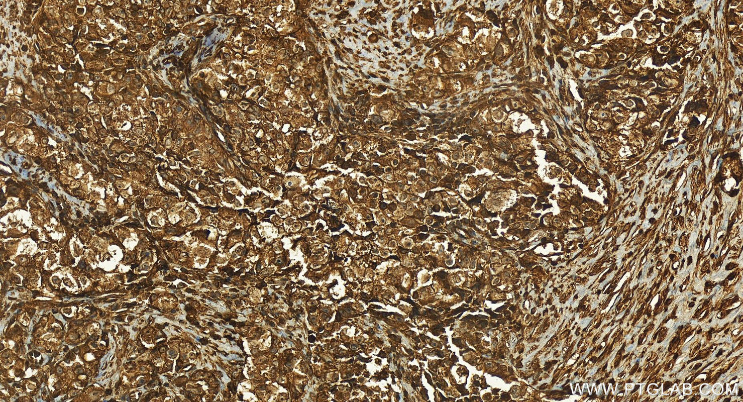 Immunohistochemistry (IHC) staining of human ovary cancer tissue using SIPA1 Polyclonal antibody (26793-1-AP)