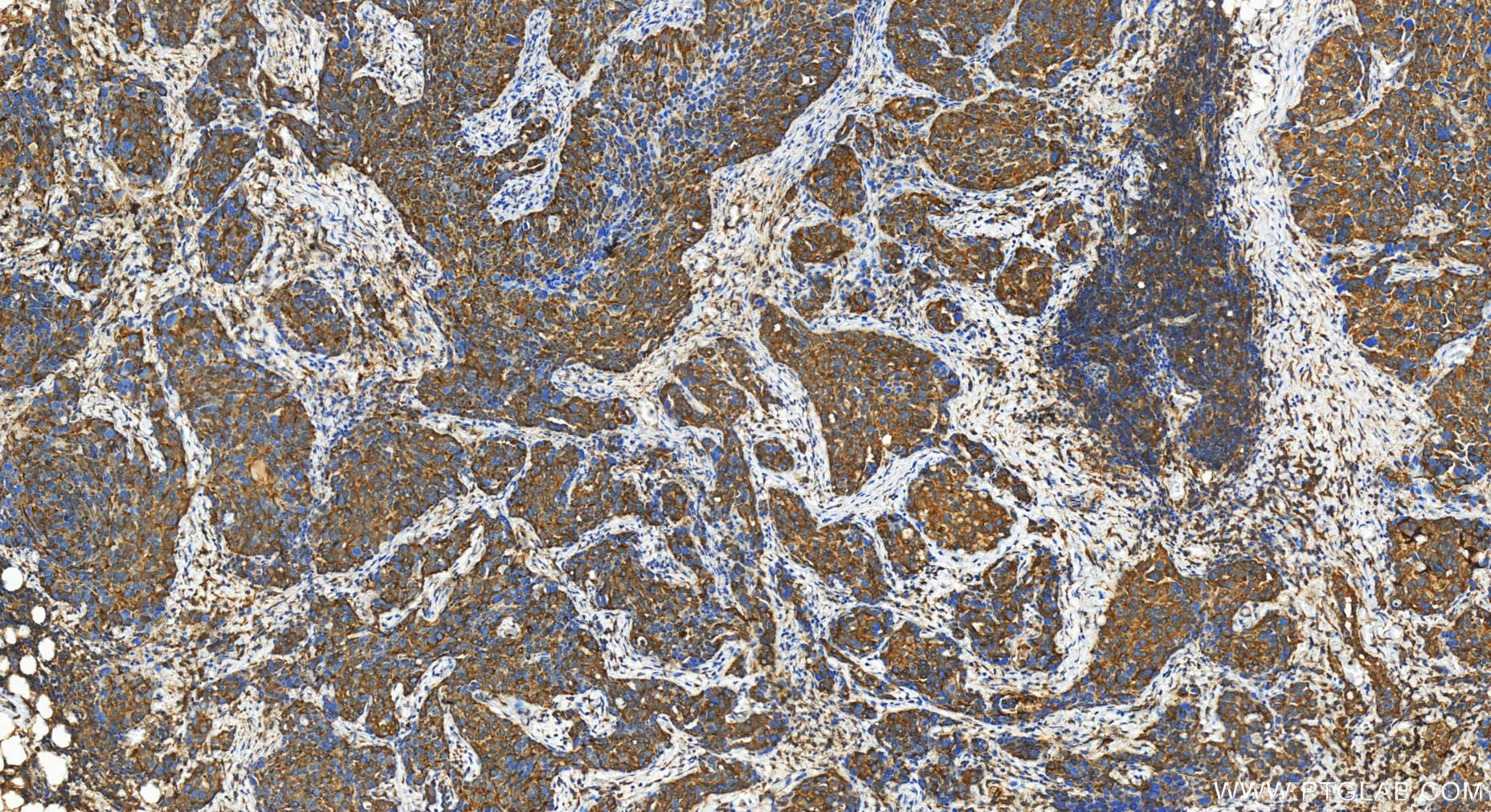 Immunohistochemistry (IHC) staining of human ovary cancer tissue using SIPA1L3 Polyclonal antibody (30544-1-AP)