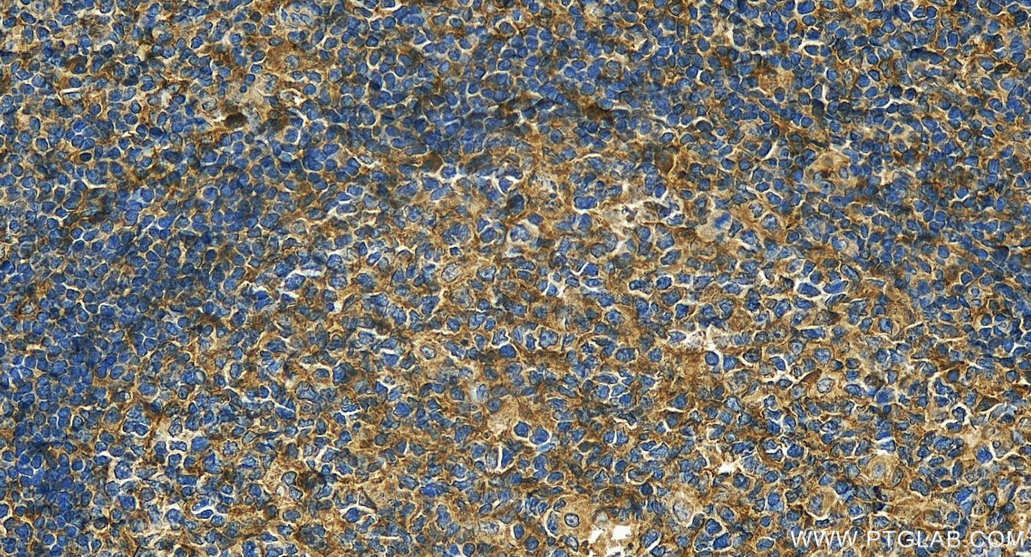 Immunohistochemistry (IHC) staining of human tonsillitis tissue using SIRP Alpha/CD172a Polyclonal antibody (14482-1-AP)