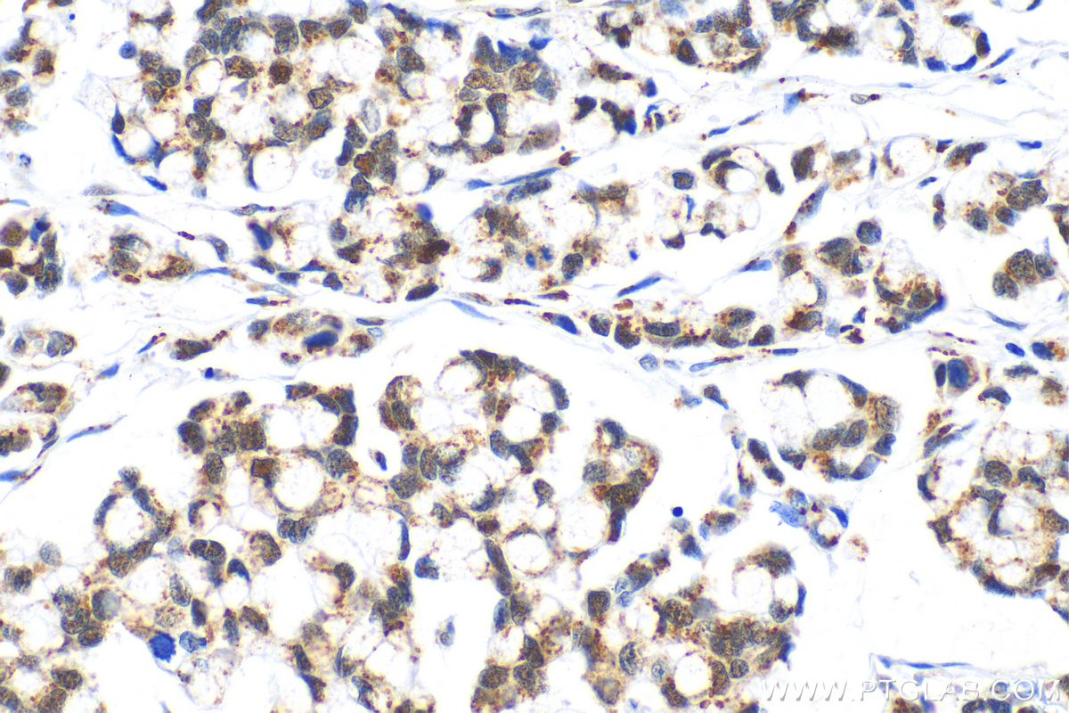 Immunohistochemistry (IHC) staining of human colon cancer tissue using SIRT1 Polyclonal antibody (13161-1-AP)