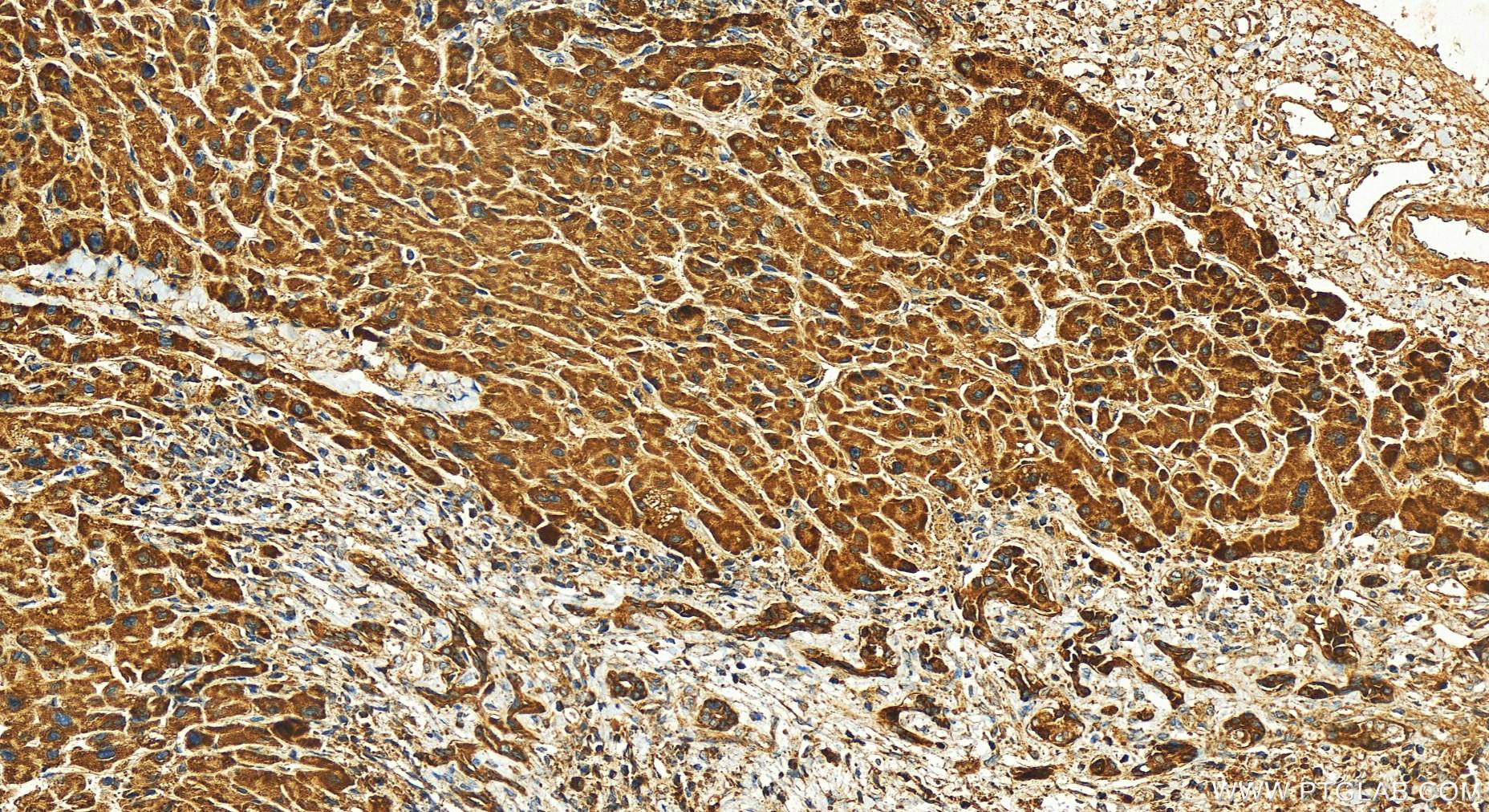 Immunohistochemistry (IHC) staining of human intrahepatic cholangiocarcinoma tissue using SIRT3 Polyclonal antibody (10099-1-AP)