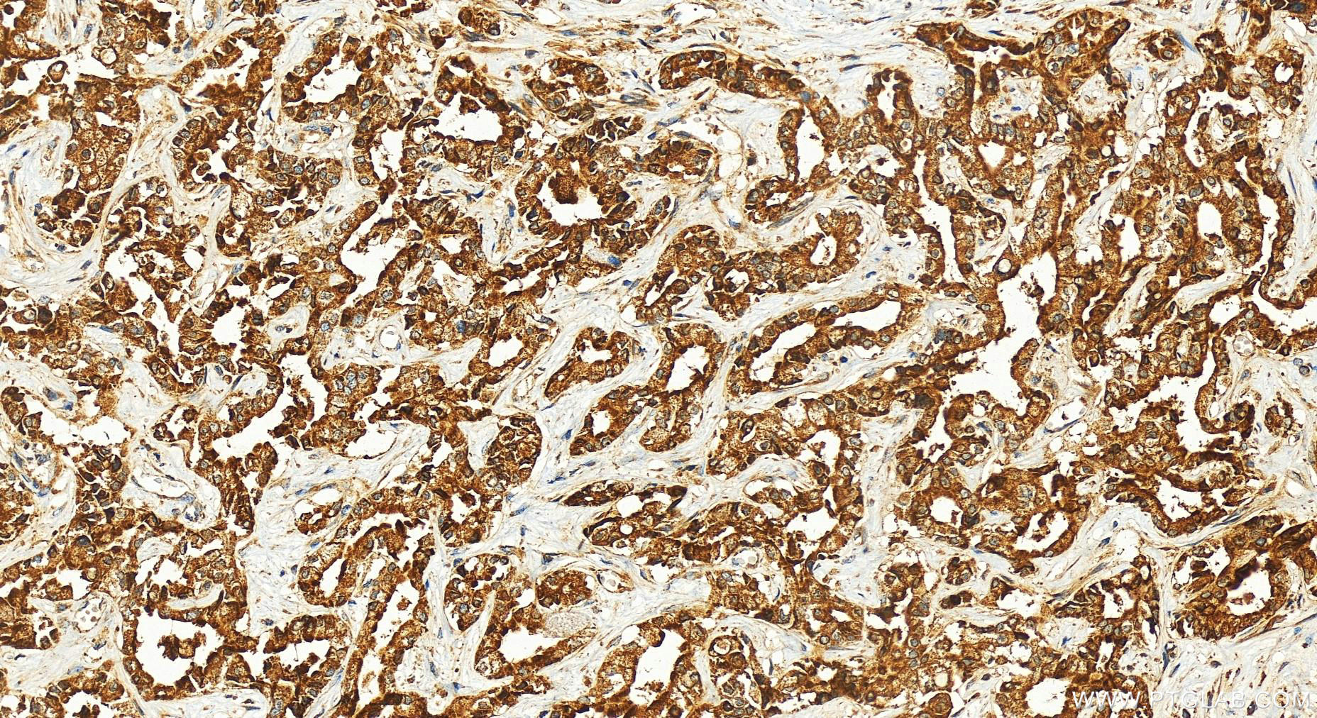 Immunohistochemistry (IHC) staining of human intrahepatic cholangiocarcinoma tissue using SIRT3 Polyclonal antibody (10099-1-AP)