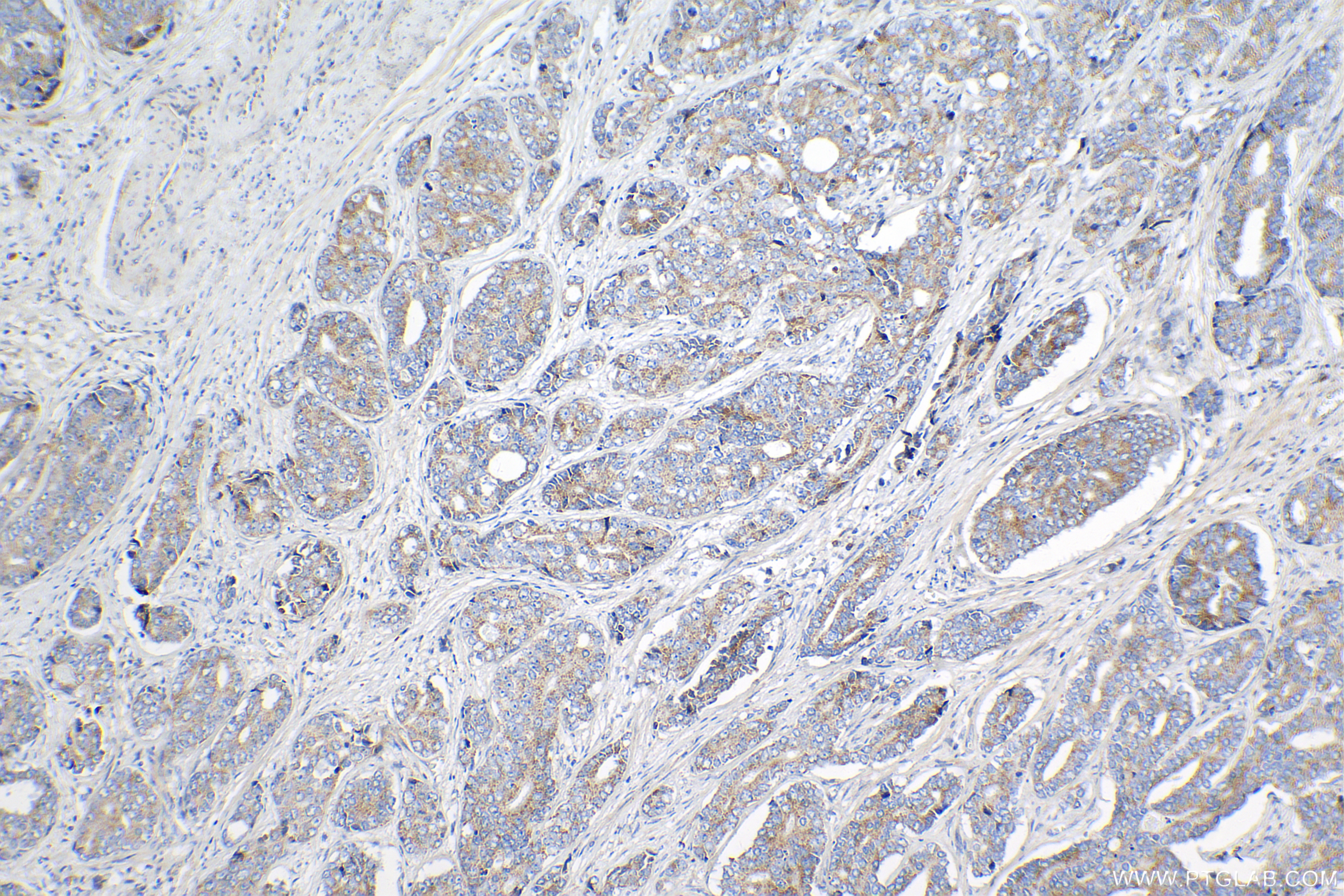 Immunohistochemistry (IHC) staining of human prostate cancer tissue using SIRT3 Recombinant antibody (82210-1-RR)