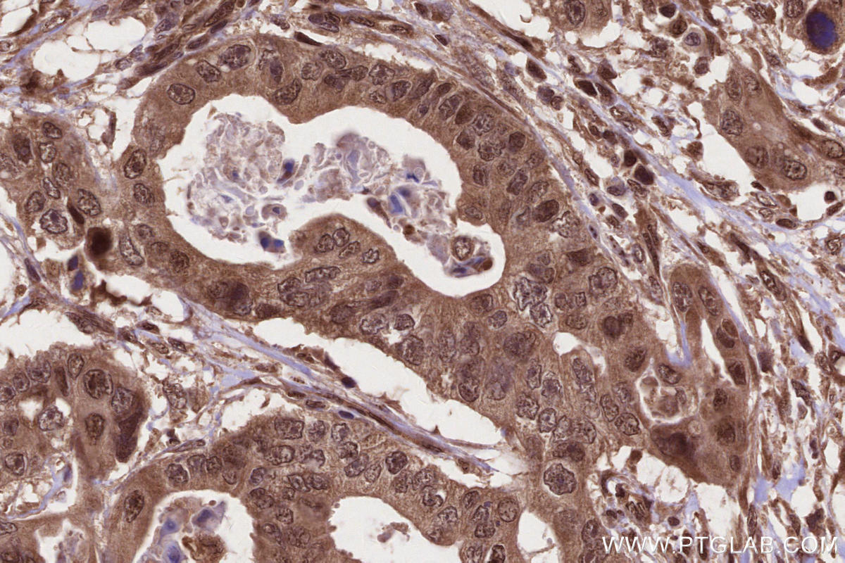 Immunohistochemistry (IHC) staining of human stomach cancer tissue using SIRT6 Polyclonal antibody (28677-1-AP)