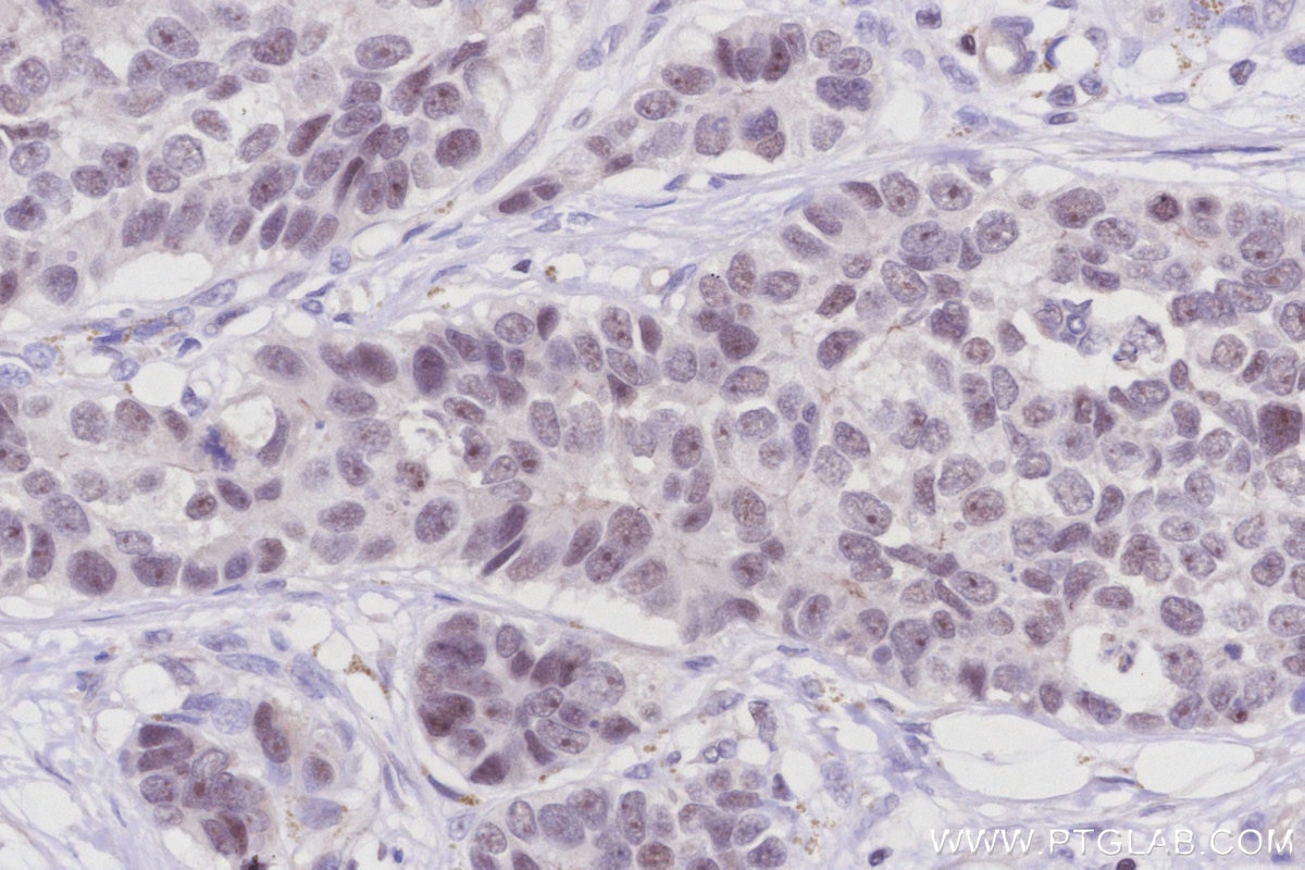 Immunohistochemistry (IHC) staining of human stomach cancer tissue using SIRT7 Polyclonal antibody (12994-1-AP)