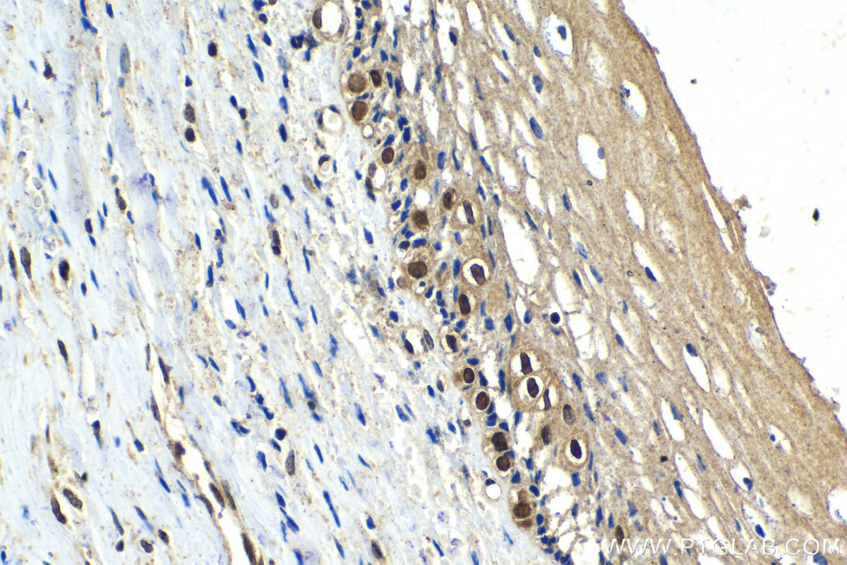 Immunohistochemistry (IHC) staining of human cervical cancer tissue using SIX4 Polyclonal antibody (21305-1-AP)