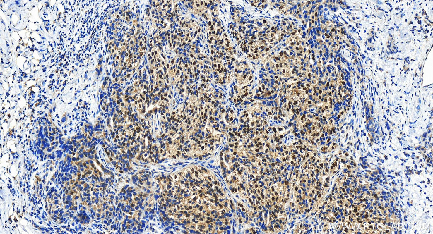 Immunohistochemistry (IHC) staining of human ovary cancer tissue using SIX4 Polyclonal antibody (21305-1-AP)