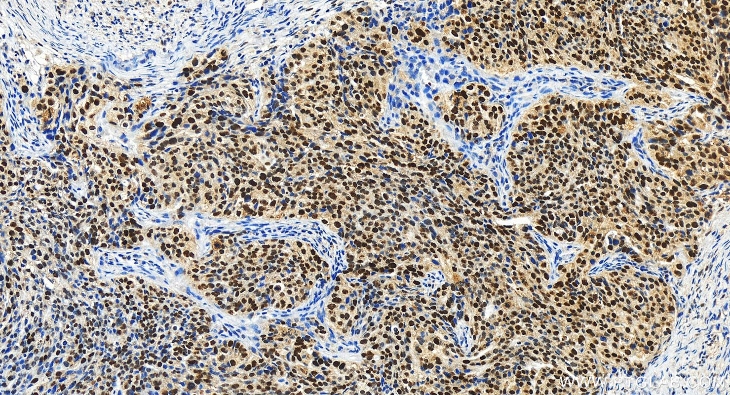 Immunohistochemistry (IHC) staining of human ovary cancer tissue using SIX4 Polyclonal antibody (21305-1-AP)