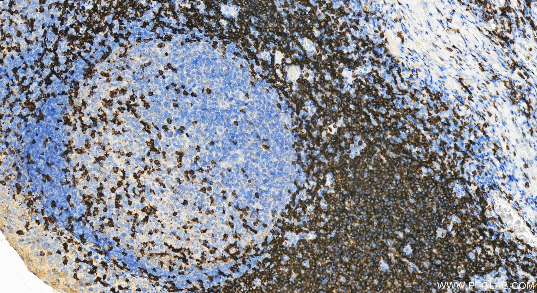 Immunohistochemistry (IHC) staining of human tonsillitis tissue using SKAP55 Polyclonal antibody (14724-1-AP)