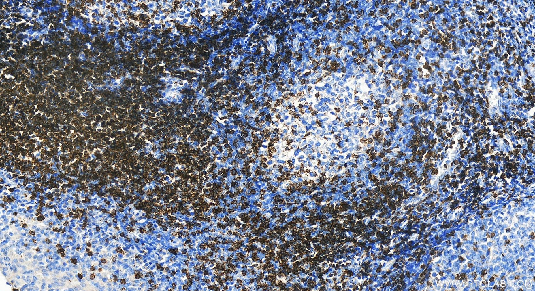 Immunohistochemistry (IHC) staining of human tonsillitis tissue using SKAP55 Polyclonal antibody (14724-1-AP)