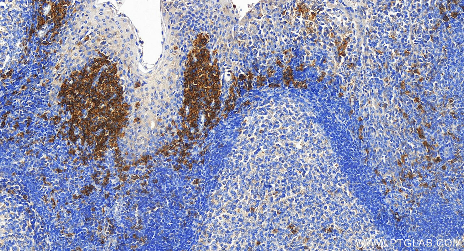 Immunohistochemistry (IHC) staining of human tonsillitis tissue using SLAMF7/CD319 Polyclonal antibody (30573-1-AP)