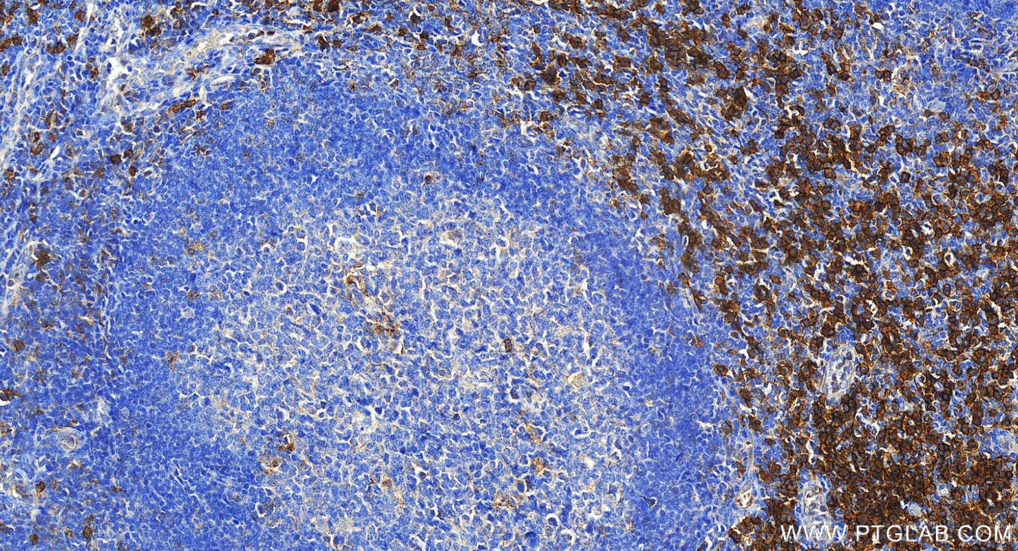 Immunohistochemistry (IHC) staining of human tonsillitis tissue using SLAMF7/CD319 Polyclonal antibody (30573-1-AP)