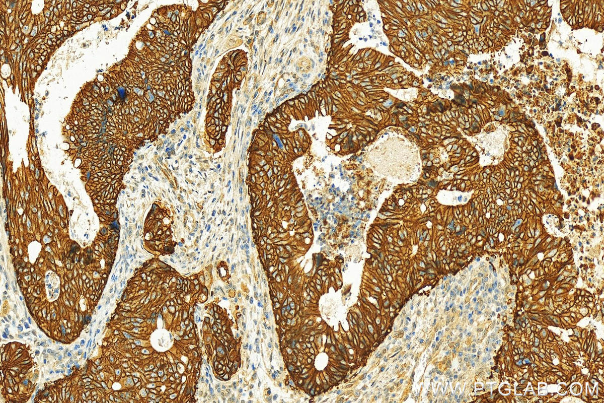 Immunohistochemistry (IHC) staining of human colon cancer tissue using NKCC1,SLC12A2 Polyclonal antibody (28055-1-AP)