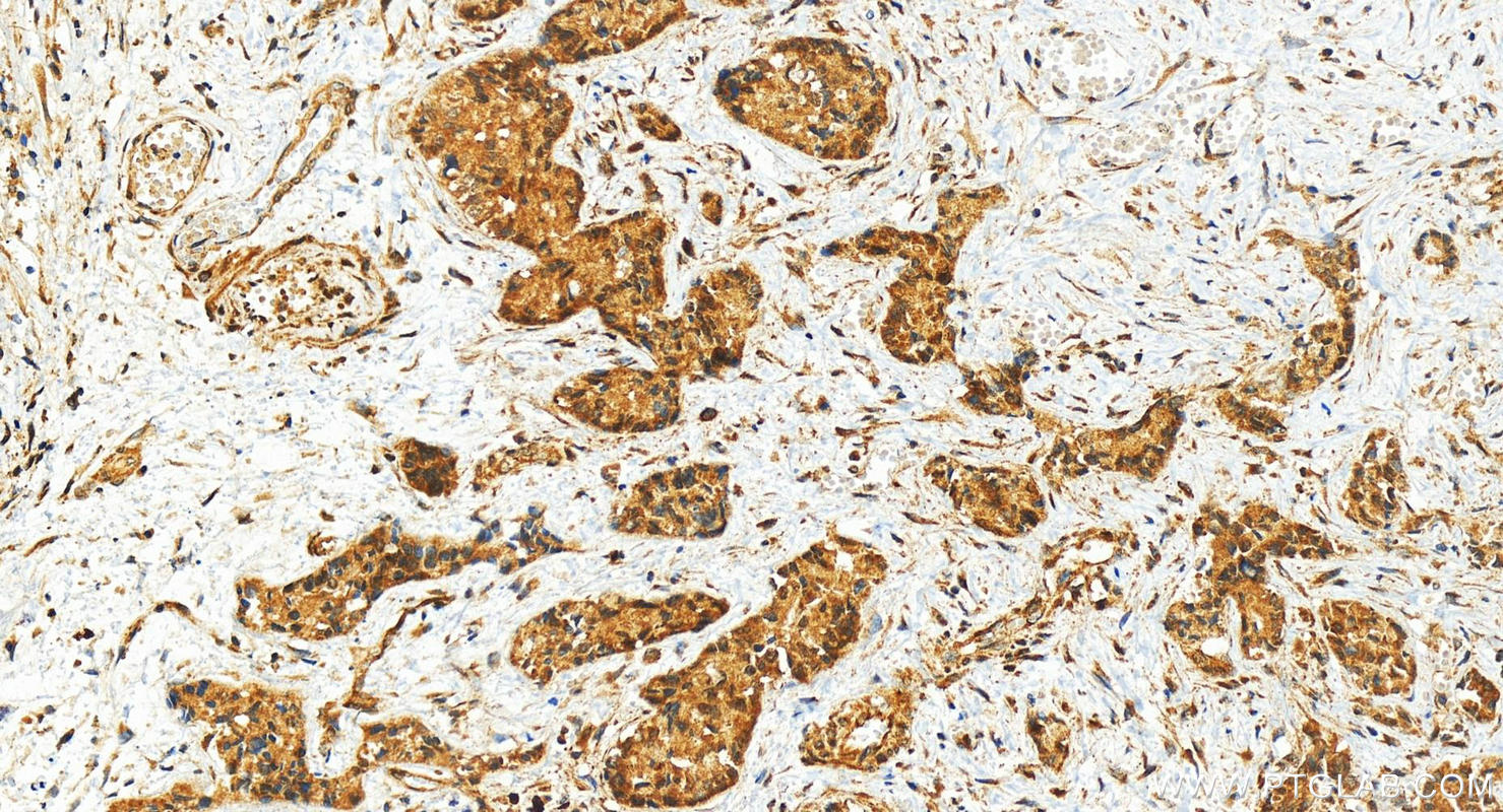 Immunohistochemistry (IHC) staining of human intrahepatic cholangiocarcinoma tissue using SLC12A8 Recombinant antibody (83225-2-RR)