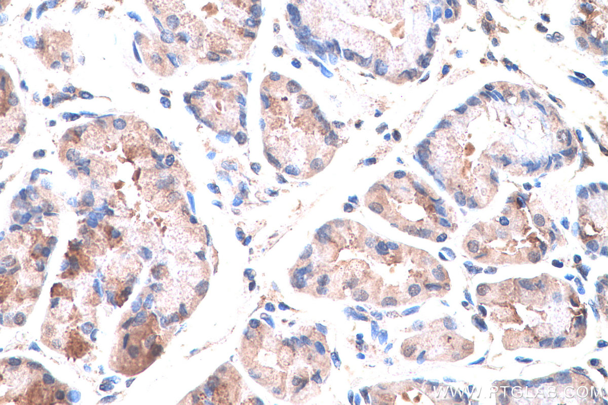 Immunohistochemistry (IHC) staining of human stomach cancer tissue using SLC16A12 Polyclonal antibody (20553-1-AP)