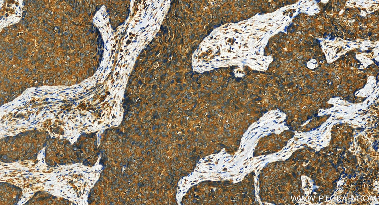 Immunohistochemistry (IHC) staining of human bowen disease using SLC20A2 Polyclonal antibody (12820-1-AP)