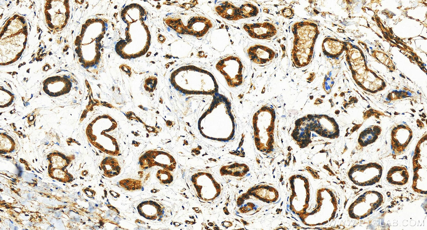 Immunohistochemistry (IHC) staining of human bowen disease using SLC20A2 Polyclonal antibody (12820-1-AP)