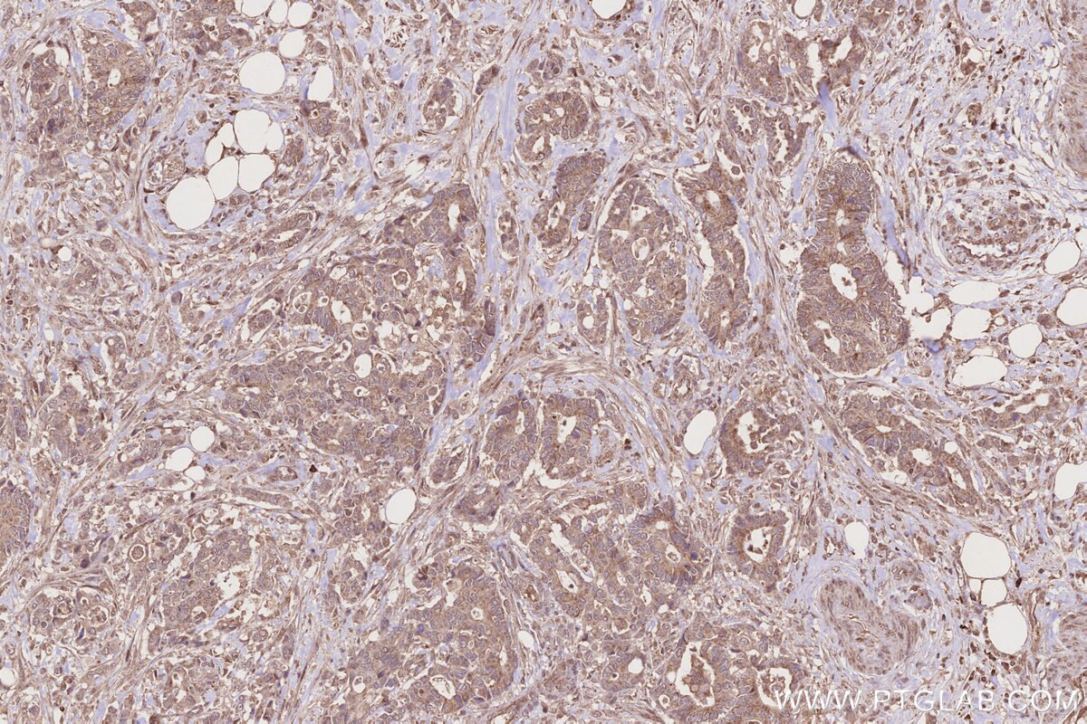 Immunohistochemistry (IHC) staining of human rectal cancer tissue using SLC25A46 Polyclonal antibody (12277-1-AP)