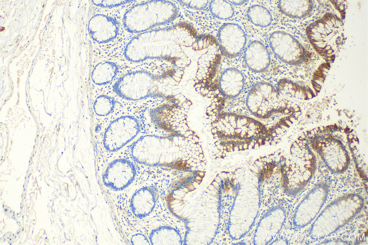 Immunohistochemistry (IHC) staining of human colon tissue using SLC26A3 Polyclonal antibody (13165-1-AP)