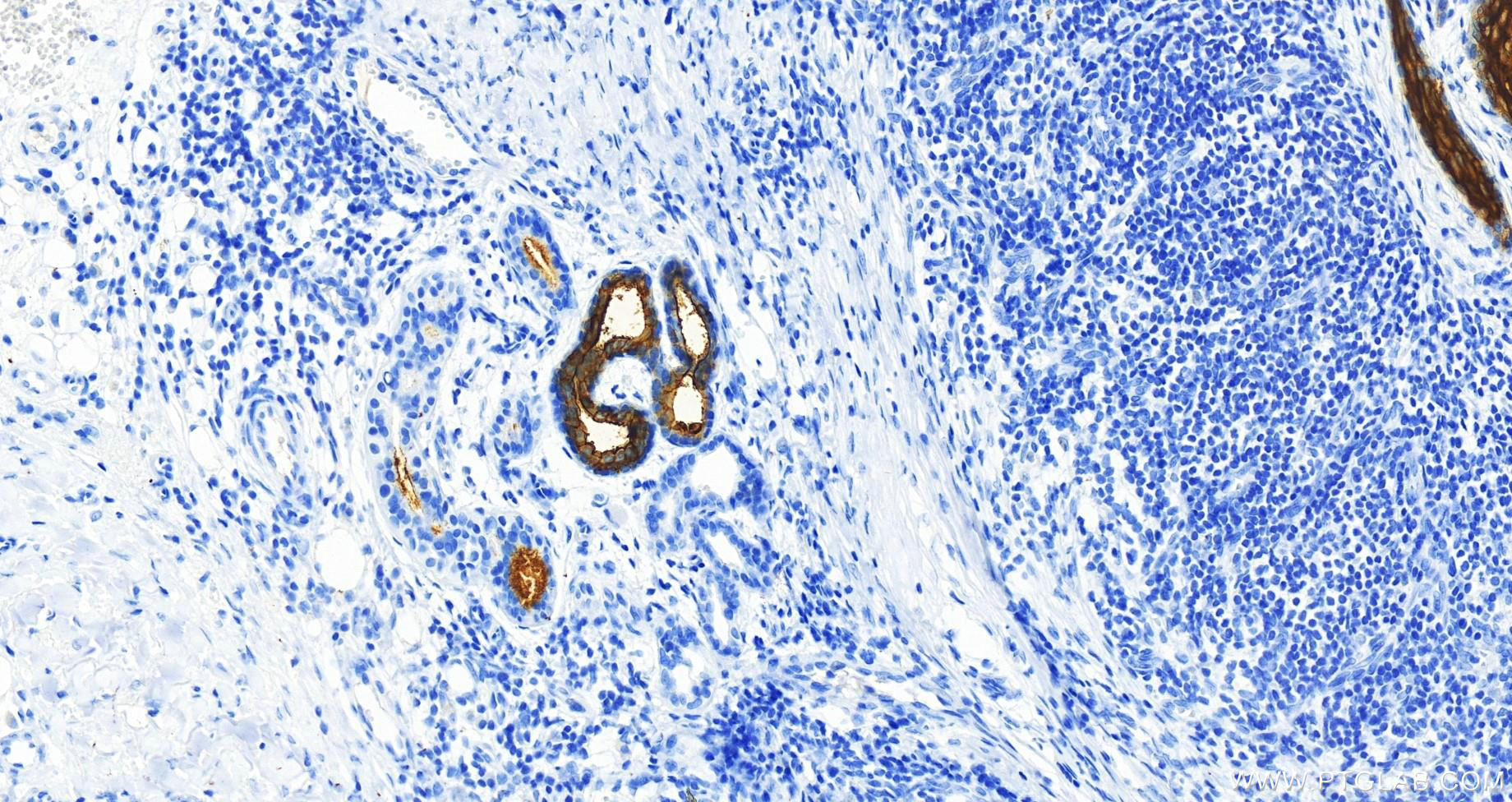 Immunohistochemistry (IHC) staining of human skin cancer tissue using GLUT1 Recombinant antibody (81463-1-RR)