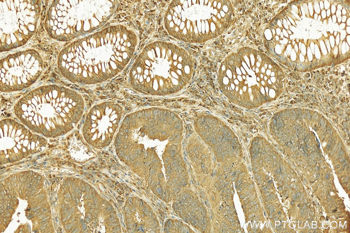 Immunohistochemistry (IHC) staining of human colon cancer tissue using SLC39A5 Polyclonal antibody (17285-1-AP)