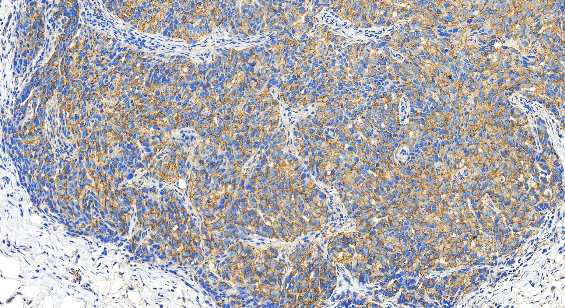 Immunohistochemistry (IHC) staining of human ovary cancer tissue using SLC43A3 Polyclonal antibody (20131-1-AP)