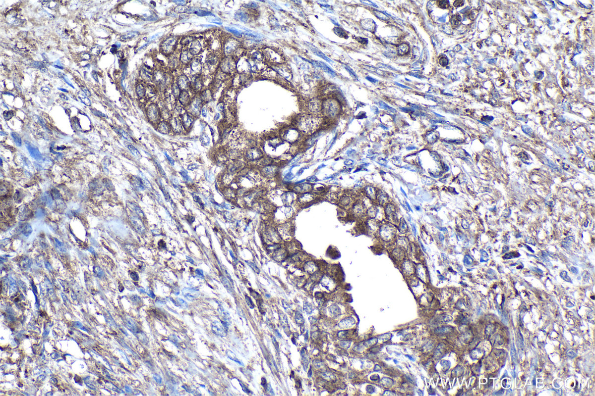 Immunohistochemistry (IHC) staining of human prostate cancer tissue using Prostein Monoclonal antibody (60343-1-Ig)