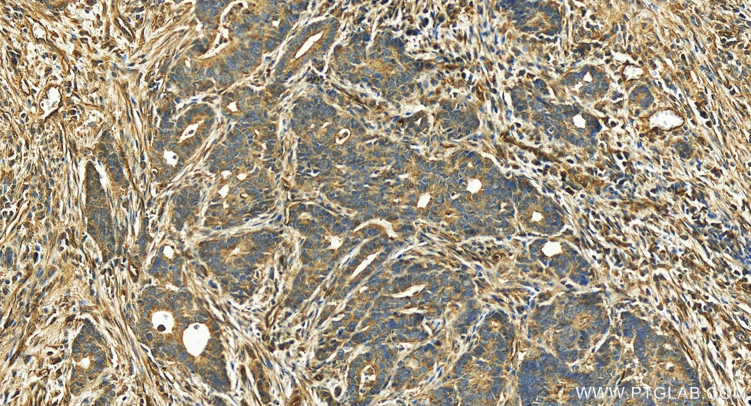 Immunohistochemistry (IHC) staining of human stomach cancer tissue using SLC9A3R2 Polyclonal antibody (18891-1-AP)