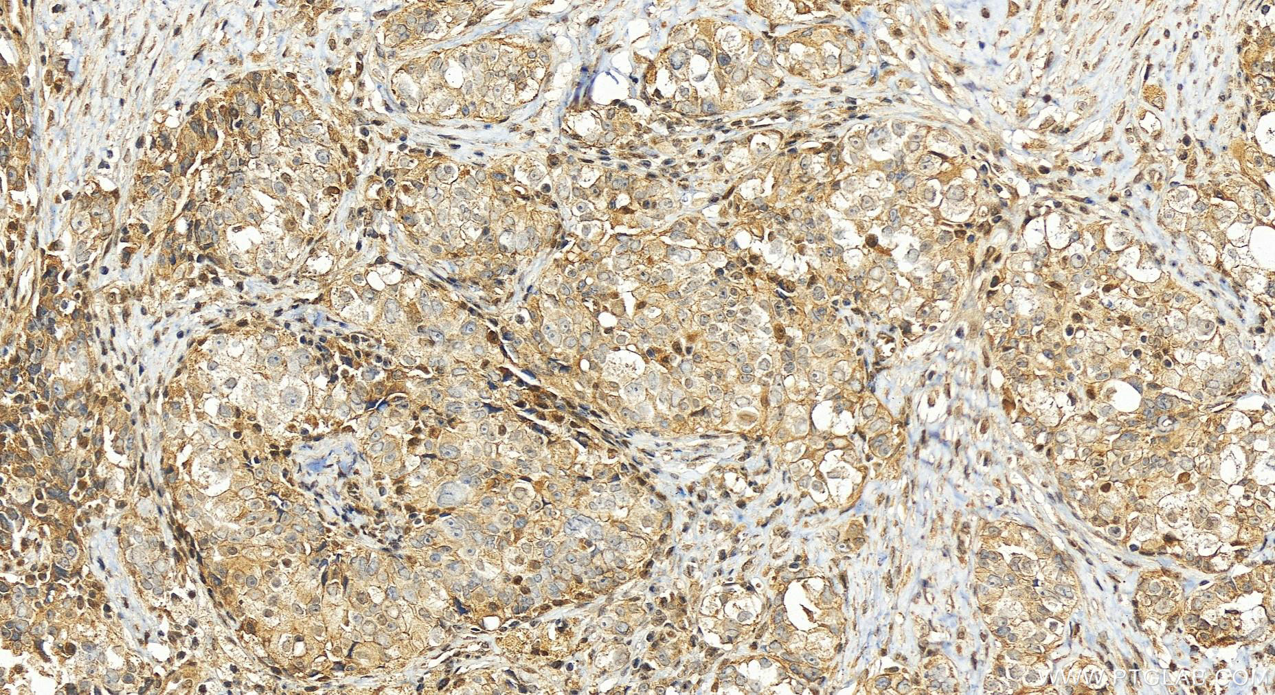 Immunohistochemistry (IHC) staining of human ovary cancer tissue using SLFN11 Polyclonal antibody (26060-1-AP)