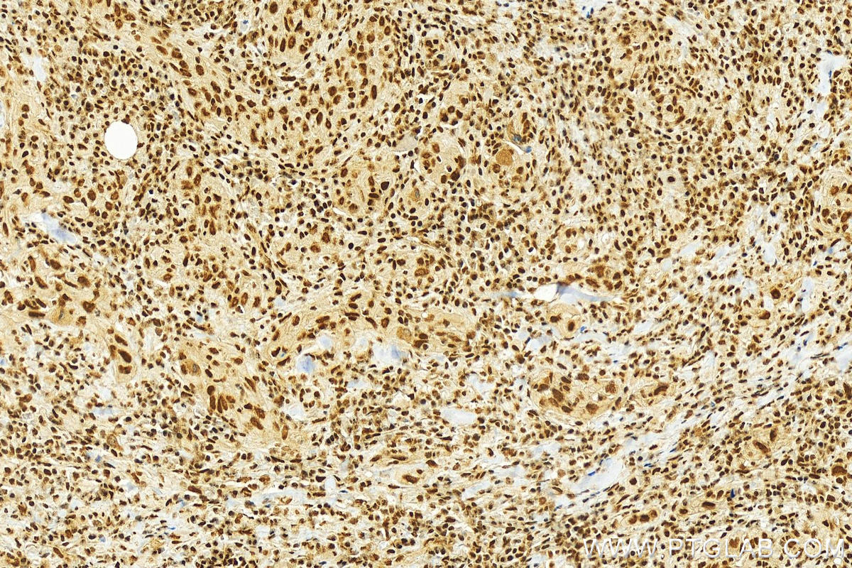 Immunohistochemistry (IHC) staining of human skin cancer tissue using SLTM Polyclonal antibody (17889-1-AP)