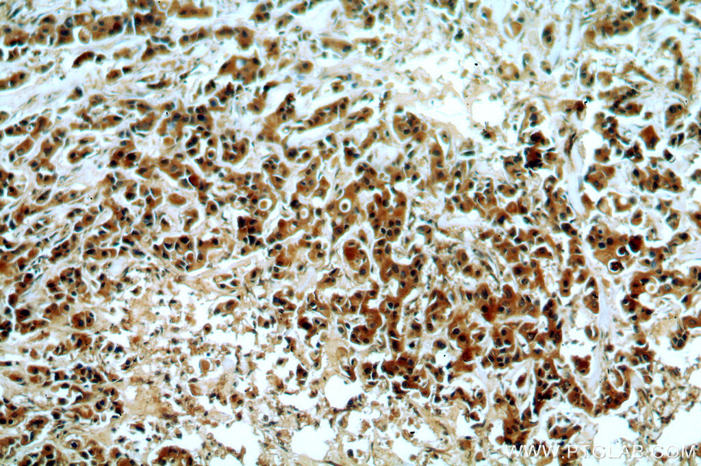 Immunohistochemistry (IHC) staining of human breast cancer tissue using SMAD3 Polyclonal antibody (51145-1-AP)