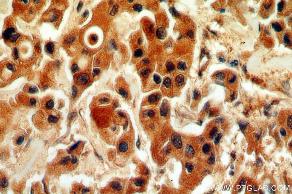 Immunohistochemistry (IHC) staining of human breast cancer tissue using SMAD3 Polyclonal antibody (51145-1-AP)