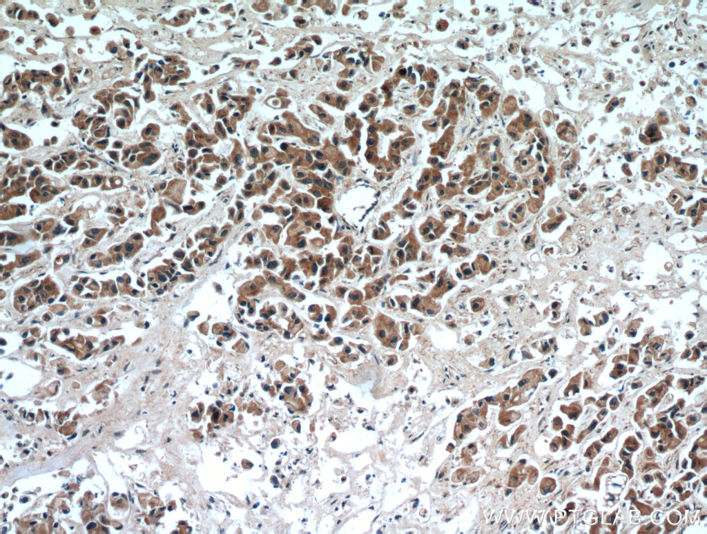 Immunohistochemistry (IHC) staining of human breast cancer tissue using SMAD3 Polyclonal antibody (51145-1-AP)