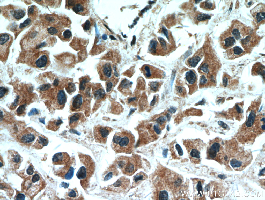 Immunohistochemistry (IHC) staining of human breast cancer tissue using SMAD3 Polyclonal antibody (51145-1-AP)