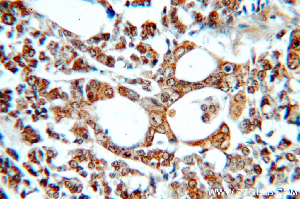 Immunohistochemistry (IHC) staining of human colon cancer tissue using SMAD3 Polyclonal antibody (51145-1-AP)