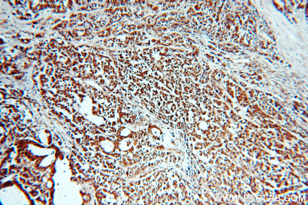 Immunohistochemistry (IHC) staining of human colon cancer tissue using SMAD3 Polyclonal antibody (51145-1-AP)